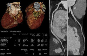 Coronary computed tomography angiography of a non-competitive athlete performed with a new-generation scanner (SOMATOM Force, Siemens Healthcare), using an ultra-low radiation dose of 0.5 mSv. Left: volume rendering technique images and study protocol; middle: nonobstructive mixed plaque in the proximal segment of the right coronary artery; right: nonobstructive calcified plaque in the proximal left anterior descending artery. LAD: left anterior descending artery; RCA: right coronary artery.