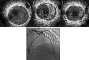 Intravascular ultrasound confirms the diagnosis of plaque rupture with persistence of a lesion of the media of the artery.