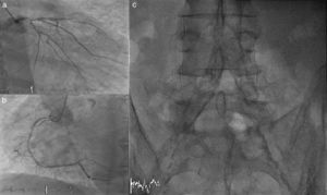 (a, b) Invasive angiogram showing severe coronary artery disease affecting the distal part of the left main and proximal segments of the three vessels. (c) Fluoroscopy revealing very severe calcification of the terminal abdominal aorta and bilateral iliofemoral arteries.