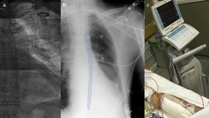 (a) Fluoroscopy reconstruction showing antegrade placement of an intra-aortic balloon pump at the descending aorta with the proximal radiopaque marker distal to the emergence of the subclavian artery (blue arrow). (b) Bedside chest X-ray on postoperative day 1 (balloon pump position is highlighted in blue). (c) Effective 1:2 counterpulsation through 7 Fr transbrachial access.