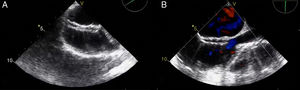 TEE images demonstrate that the occluder device was properly deployed in the middle part of the interatrial septum (A) and there was no residual shunt through it (B).