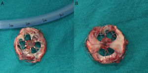 Imaging of the occluder device after surgical extraction from the front (A) and the back (B) sites.