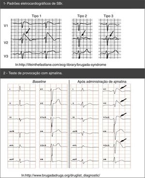 Padrões eletrocardiográficos de SBr: espontâneos (1) e após teste de provocação com ajmalina (2).