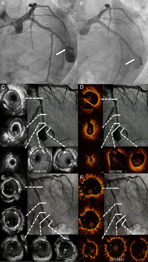 A) Angiographic comparison (spider view). Pre-treatment. The white arrow points out the aneurysm's neck area. B) Final angiographic result. C) Initial IVUS LCx imaging study. D) Initial OCT LCx imaging pullback. E) Final IVUS LCx imaging pullback. F) Final OCT LCx imaging pullback.