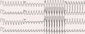 Eletrocardiograma de 12 derivações