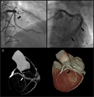 Panel A: coronary angiography (right cranial view) showing LAD occlusion; Panel B: large caliper vessel uncovered after LAD balloon pre-dilatation (left cranial view); Panel C: documentation of a fistula from the middle segment of the LAD into the coronary sinus by CT angiography.