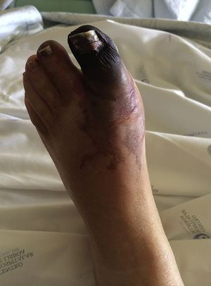 Bluish-black discoloration of the left hallux (in mummification process), second left toe and distal dorsal face of the foot.