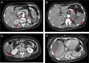 CT scan of the abdomen/pelvis showing total hypodensity of the spleen representing a complete infarct, without contrast enhancement except for a fine capsule. Splenic artery occlusion. Hypodense ill-defined lesion in the pancreas tail, measuring 55×38 mm with adjacent fat densification, but without contrast enhancement leading to a differential diagnosis between ischemic infarct and malignant neoplasm. Heterogeneous contrast enhancement of both kidneys, with triangular parenchymal areas of lower attenuation, suggestive of ischemic renal foci. Heterogeneous hepatomegaly with areas of non-contrast enhancement, the biggest one in segments VII and VIII; similar area on the liver border and smaller hypodense areas that, in this context, can represent occlusive arterial conditions. Small parietal thrombus (9mm) in the left lateral aortic wall, in the axial plane of the celiac trunk, with no evident atheromatous lesions.