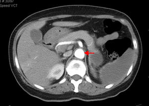 Abdominal aortic lumen patent throughout its trajectory, without identifiable thrombus. The ischemic clinical presentations described in the previous CT scan are identified, with better pancreatic ischemic lesion definition.