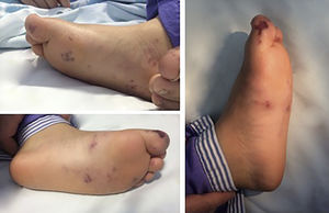 Purpuric rash and edema of both feet.
