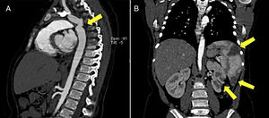 CT scan. A – sagittal view showing the aortic coarctation (arrow); B – coronal view showing the splenic and renal low-density areas, suggestive of infarcts (arrows).