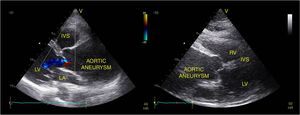 Echocardiogram with Doppler IVS: interventricular septum; LA: left atrium; LV: left ventricle; RV: right ventricle.
