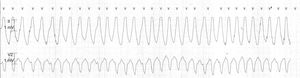 Monomorphic ventricular tachycardia with morphology suggestive of right ventricular outflow tract origin.