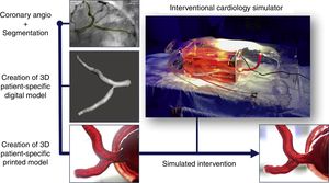 The steps for creating a patient-specific 3D coronary model for simulation are depicted. They include segmentation of the coronary angiography in order to create a 3D patient-specific digital model, and post-processing to obtain a flexible and transparent patient-specific physical model that could be connected to the custom interventional cardiology simulator SimulHeart®. The images on the bottom show the ostial circumflex stenosis model on visual inspection (left) and the post-intervention result after stent placement (right).