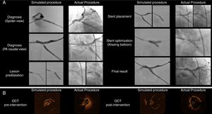 Side-by-side display of matched angiographic appearance (Panel A) and OCT imaging (Panel B) of patient-specific simulated procedure and actual procedure for comparative purposes. (Panel A) Angiographic images depicting the sequential procedural steps from diagnosis to final surgical result. (Panel B) OCT still frames of minimal luminal area before intervention and the final result after stent implantation.