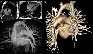 Magnetic resonance imaging, magnetic resonance angiography (MRA) and computed tomography angiography (CTA) images. A) Image of a small cardiac magnetic resonance imaging (CMRI) axis showing dilatation of the right ventricle (thin white arrow). B) Long-term CMRI showing dilatation of the right ventricle (thin white arrow). C) Maximum intensity projection in the anterior view of the coronal plane of the MRA, with the wings of the left upper lobe (LUL) and the apical segment of the left lower lobe (LLL) towards the venous trunk of a common vein (asterisk) for the left brachycephalic venous trunk. D) Rear view of the three-dimensional volume-rendering CTA images revealing a common vein for the LUL and the LLL of the left brachiocephalic venous trunk.