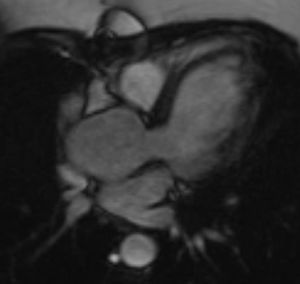 Long-axis three-chamber-view CMR of a 24-year-old patient with TS, showing dilatation of the ascending aorta, with ASI >2.5 cm/m2 indicating a high risk of dissection.