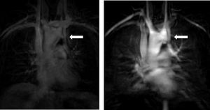 CMR angiography of a PLSVC (white arrow) in a TS patient.