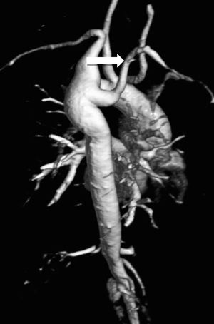 Volume-rendered magnetic resonance aortography (posterior-oblique view) showing an aberrant right subclavian artery (white arrow) in a 37-year-old TS woman.