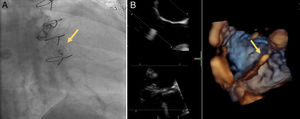 Migration of the device into the left ventricle (A) and attempt to retrieve it with a snare (B).