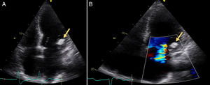 Device entrapped in the subvalvular mitral apparatus (A), with no significant compromise of mitral valve function (B).