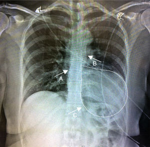 Chest X-ray showing marked levoposition and a “teardrop” appearance (dashed white line) of the cardiac silhouette, loss of right heart border due to superimposition over the spine (A), prominent main pulmonary artery (B) and translucent area between the diaphragm and the heart (C).