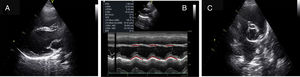 Transthoracic echocardiogram images. (A) Parasternal long-axis view, bi-dimensional mode. (B) Parasternal long-axis view, M-mode, showing paradoxical septal motion. (C) Parasternal short-axis view of the base, showing apparent right ventricular dilation.