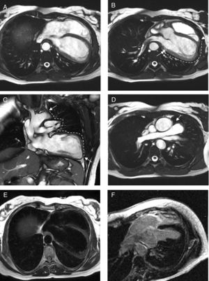Cardiac MRI images. (A-D) Steady-state free precession images. (A) Axial image showing left and posterior heart displacement. (B) Axial image displaying non-visualization of the pericardium and pericardial fat around the left ventricle (between the white arrows). (C) Coronal image showing absence of the pericardium and pericardial fat around the left ventricle and great vessels (between the white arrows), with lung tissue interposition in the several recesses where the pericardium is usually found. (D) Axial image showing lung tissue in the aorto-pulmonary window (white arrow), which is considered a pathognomonic sign of this condition. (E) T1-weighted axial image with no abnormalities, particularly, fat tissue deposition. (F) Delayed gadolinium-enhanced axial image with no macroscopic areas of myocardial fibrosis/necrosis.