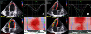 Left (A) and right (B) ventricular longitudinal strain analysis by two-dimensional speckle tracking.