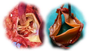 Solo bioprosthetic valve with structural valve deterioration (left); en bloc explantation of Solo valve (right).