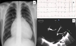 A: Chest X-ray revealing cardiomegaly with no pulmonary artery dilatation; B: Electrocardiogram showing atrial fibrillation and right bundle branch block. C: Transthoracic echocardiography showing severe right chambers dilation, particularly of the right atrium, and a large ostium secundum atrial septal defect.