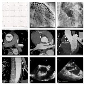 (A) Electrocardiogram on admission; (B) left coronary artery with no atherosclerotic disease; (C) aortography showing mild aortic regurgitation and no signs of ascending aortic dissection; the origin of the left coronary artery can be visualized but the right coronary artery cannot; (D-G) computed tomography angiography showing circumferential wall thickening of the thoracic aorta (arrows), causing occlusion of the right coronary ostium (arrowheads); (H) transesophageal echocardiography (TOE) showing circumferential thickening of the thoracic aorta; (I) TOE showing dilated right ventricle.