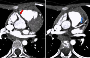 Tomografia Axial Computorizada cardíaca que mostra a coronária direita com origem no seio de Valsalva direito (seta vermelha) e a esquerda com origem na face póstero‐lateral esquerda do tronco da artéria pulmonar (seta azul).