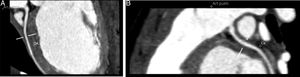 Coronariografia por TC multidetectores ‐ 64 cortes, ECG gated. Reformatações multiplanares e curvas Tronco comum da artéria coronária esquerda com origem na vertente inferior esquerda do tronco da artéria pulmonar. O tronco comum apresenta um calibre de 2,6mm e uma extensão de cerca de 3mm, tem contornos regulares e permeabilidade preservada. O tronco comum apresenta a normal bifurcação em artéria descendente anterior (A) e circunflexa (não dominante) (B). Estes vasos têm permeabilidade preservada na porção visualizada – sua metade proximal.