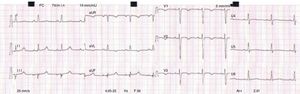 Electrocardiogram: sinus rhythm and inversion of the T waves in leads aVL and V1-V3.