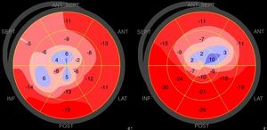 Examples of polar maps of peak systolic longitudinal strain obtained from a Takotsubo syndrome patient (left) and an anterior ST-segment elevation myocardial infarction patient (right).