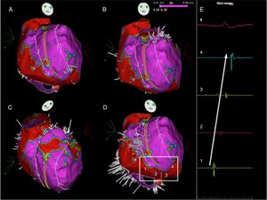 Ripple map displayed over a bipolar voltage map depicting the circuit of the initial flutter, showing an activation front ascending anteriorly to the crista terminalis (parallel yellow lines), going around the right atrial appendage and descending between the crista terminalis and the intercaval line (A to D) to a slow conducting isthmus. As the isthmus is a cicatricial zone, the Ripple bars are smaller in number and in amplitude. As such, four Ripple marks and corresponding electrograms are displayed and marked from 1 to 4 (D and E). The slow conduction through the critical isthmus began at mark 1 and spread to mark 4.