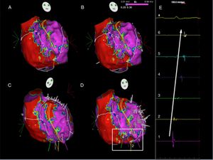 Ripple map of the second flutter, displayed over a bipolar voltage map: the wavefront ascended between the crista terminalis and the intercaval line, went around the right atrial appendage and descended anteriorly to the crista terminalis (A to D) through the slow conducting isthmus. As the isthmus is a cicatricial zone, the Ripple bars are smaller in number and in amplitude. As such, six Ripple marks and corresponding electrograms are displayed and marked (D and E). The slow conduction through the critical isthmus began at mark 1 and spread to mark 6.