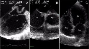 A – Transesophageal echocardiography (TEE) reveals the passage of a large thrombus through the patent foramen ovale, which later led to stroke. B – TEE shows a smaller thrombus following the initiation of unfractionated heparin. C – Transthoracic echocardiography reveals no thrombus.