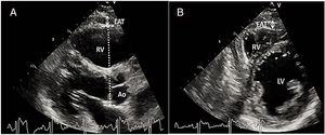 Measurement of EAT thickness. (A) Parasternal long-axis view; (B) parasternal short-axis view. Ao: aorta; EAT: epicardial adipose tissue; LV: left ventricle; RV: right ventricle.