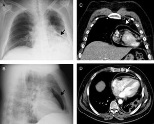 Chest X-ray on admission showing a radiolucent band of air partially surrounding the heart (arrows) consistent with pneumopericardium, in posteroanterior (A) and lateral (B) views; chest computed tomography scan confirming the presence of pneumopericardium (arrows), in coronal (C) and axial (D) views.