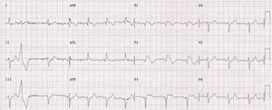Eletrocardiograma com padrão de Brugada tipo 1.