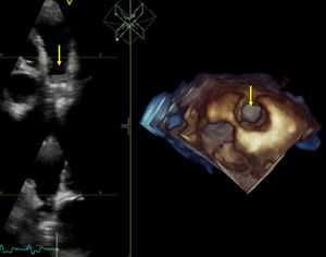 Imagem 3D do conduto que conecta o VD do coração dador à artéria pulmonar nativa, com obstrução aparente (seta amarela).