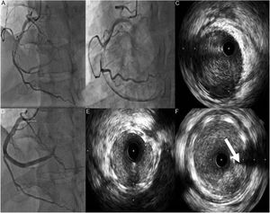 A e B: Coronariografia evidenciando artéria coronária direita (CD) com disseção espontânea desde o segmento médio com trombo condicionando fluxo TIMI 1. C: Imagem de IVUS mostrando disseção desde o ramo póstero‐lateral até ao segmento médio da CD com grande quantidade de trombo. D: Implantação de três stents com fármaco em overlap. E e F: Imagem de IVUS mostrando stents com boa expansão e aposição e protrusão de trombo (seta).