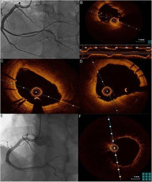 A: Follow‐up angiográfico após uma semana. B, C e D: Imagem de OCT evidenciando disseção do ramo póstero‐lateral com grande carga trombótica. E: Follow‐up angiográfico aos seis meses após evento agudo. F: Follow‐up com OCT aos seis meses após evento agudo.