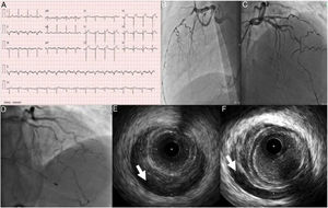A: Eletrocardiograma da admissão. B e C: Coronariografia evidenciando artéria descendente anterior (DA) com disseção espontânea ocupando todo o segmento médio e distal estendendo‐se até ao ramo póstero‐lateral. D: Coronariografia realizada após paragem cardiorrespiratória 30h após admissão, evidenciando aparente progressão proximal da disseção D e F: Imagem de IVUS a evidenciar hematoma intramural desde a DA proximal (seta).