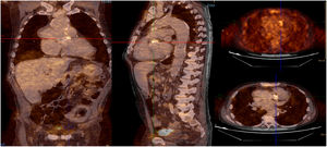 Infective endocarditis (IE) in a mechanical aortic valve in a 68-year-old male with a history of Bentall procedure and intermediate suspicion of IE. On transesophageal echocardiography, an aortic pseudoaneurysm was observed in the valvular plane with a diameter of 67 mm×44 mm and with an image of a thrombus inside. On 18F-FDG PET study, hypermetabolism was observed in the mechanical aortic valve with SUVmax of 4.49 g/ml.