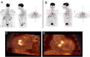 Infective endocarditis in the native mitral valve and bioprosthetic aortic valve in an 88-year-old male hospitalized due to persistent fever and blood cultures positive for Streptococcus viridans. Echocardiographic results show a vegetation on the native mitral valve and no alterations in the bioprosthetic aortic valve. 18F-FDG PET images show two positive uptake foci, in (A) the native mitral valve (SUVmax 7.5) and (B–D) the prosthetic aortic valve (SUVmax 5.1).