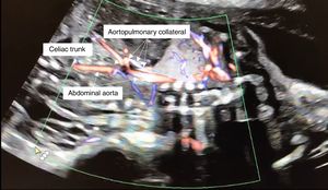 Fetal echocardiogram (sagittal view) showing an aortopulmonary collateral artery arising from the abdominal aorta, proximally to the celiac trunk.