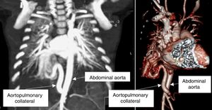 Computed tomography scan (coronal view) showing a serpentine aortopulmonary collateral artery originating in the abdominal aorta (left) and three-dimensional reconstruction (right).